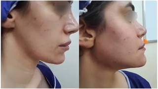 تزریق چربی برای مراجعه کننده عزیزمون