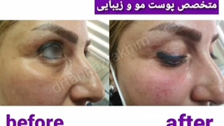 ترکیب فیلر و نخ زیر چشـــم