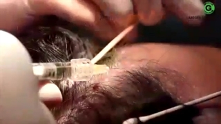 آموزش تزریق هیرفیلر