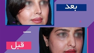 عمل بینی استخوانی با جابجایی غضروف و تعبیه پروتز غضروفی