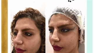 لیفت شقیقه در اهواز