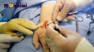 فیلم واقعی و بدون سانسور عمل سندرم تونل کارپ یا کارپال تانل