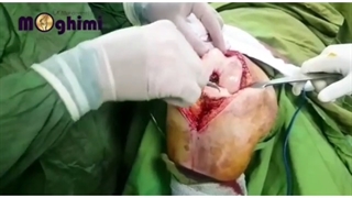 عمل بدون سانسور تعویض مفصل زانو