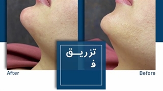 فیلر چانه زیبایی پوست