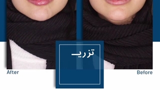 تزریق فیلر لب