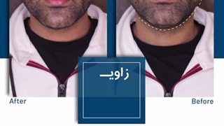 زاویه سازی صورت آقایان