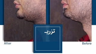 فیلر چانه میکرونیدلینگ