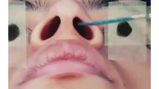 فیلم جراحی بینی