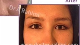 جراحی زیبایی چشم شرقی