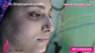 عمل بینی استخوانی