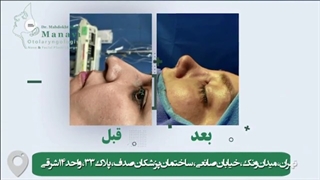 جراحی افتادگی نوک بینی با مدل فانتزی