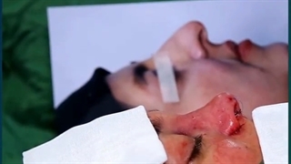 عمل بینی در قزوین