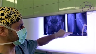 تعویض مفصل ران دوطرفه همزمان