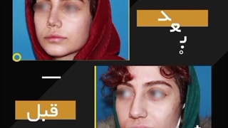 فیلم عمل بینی استخوانی با نتیجه بینی طبیعی