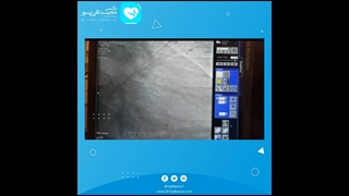 آنزیوپلاستی در بیمار باانفراکتوس وسیع قلبی