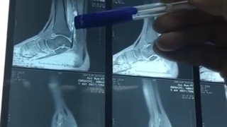 فیلم واقعی جراحی تومور استخون