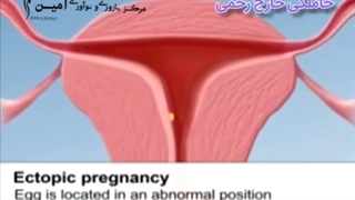 حاملگی خارج از رحم