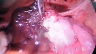 لاپاراسکوپی حاملگی خارج از رحم تخمدانی