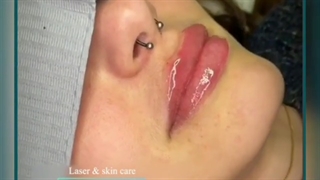 فیلم واقعی تزریق ژل لب
