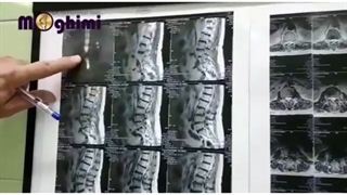 فیلم بدون سانسور جراحی تنگی کانال نخاعی در بیمار 63 ساله