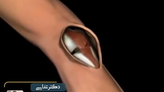 جراحی تعویض مفصل زانو را ببیند
