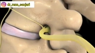 درمان آسیب های دیسک کمر