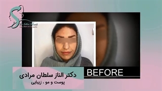 فیلم تزریق ژل به خط خنده