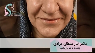 تزریق ژل به خط خنده