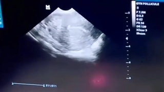 تعیین جنسیت با ivf (آی وی اف )