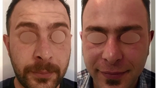 نتیجه تزریق بوتاکس