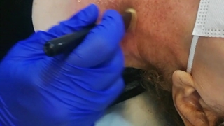 انجام پیلینگ روشن سازی گردن توسط متخصص پوست دکترناهید همتیان درکلینیک تخصصی جُوان