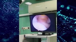 جراحی خارج سازی کیست زانو به روش آرتروسکوپی