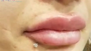 فیلر لب مدل میکس