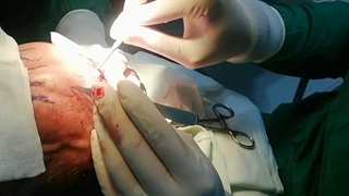 عمل لیفت پیشانی توسط جراح ومتخصص چشم (دکترسیدمحمدسالارظاهریانی)  باحفظ وبدون آسیب دیدن دوعصب مهم سوپرتروکلءار و سوپر اربیتال