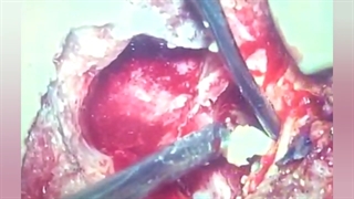 آبسه اپیدورال