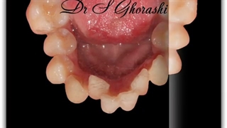 وسیع کردن قوس دندانی فک پایین و درمان ارتودنسی بدون کشیدن دندان | دکتر قریشی