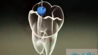 معالجه ریشه دندان