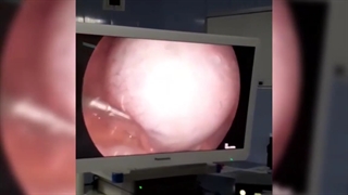 جراحی کیست تخمدان