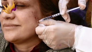 درمان لک صورت لیزر صورت