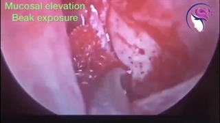 فیلم واقعی جراحی تومور چشم آقای 65 ساله