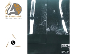 فیلم واقعی جراحی دیسک گردن و آسیب نخاع گردنی