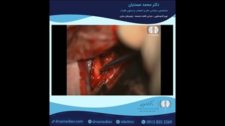 عمل جراحی میکروسکوپی آنوریسم ACOM