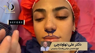 فیلم لیفت سانترال لب و قرینه سازی سوراخ های بینی