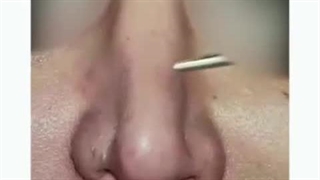 فیلم جراحی ترمیم بینی