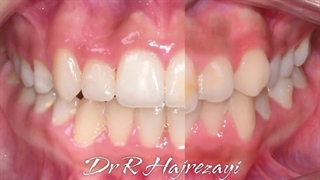 درمان ارتودنسی ثابت دو فک بدون کشیدن دندان | کلینیک تخصصی دندانپزشکی کانسپتا