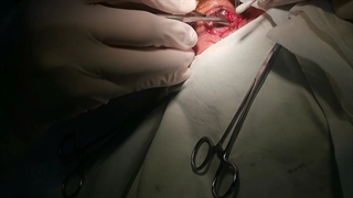 عمل برداشت ناخنک و پیوند ملتحمه ازخود چشم بیمار توسط جراح ومتخصص چشم دکترسیدمحمدسالارظاهریانی