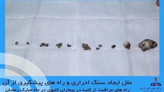 علل ایجاد سنگ ادراری و راه های پیشگیری از آن