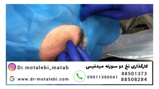 فیلم واقعی لیفت صورت با نخ دو سوزنه
