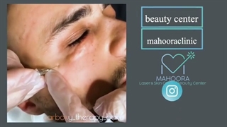 رفع دائمی تیرگی زیر چشم با کربوکسی تراپی