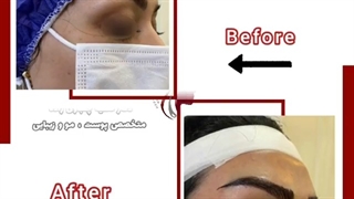 نمونه کار کاشت ابرو طبیعی